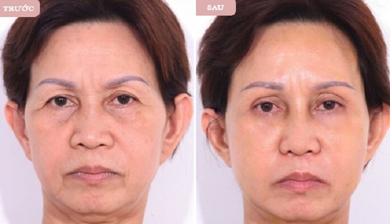 Treo cung mày giúp trẻ hóa gương mặt nhanh chóng