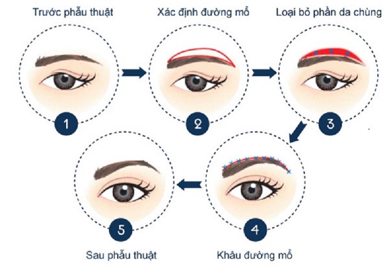 Các bước nâng cung mày chuẩn y khoa