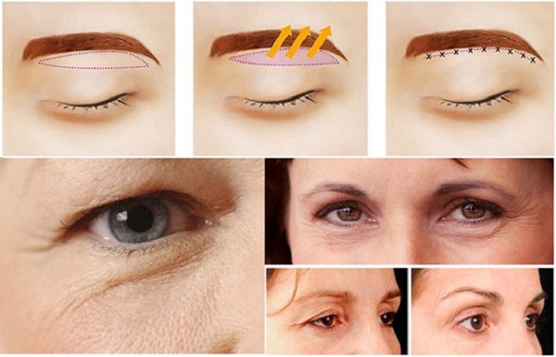Cắt treo chân mày giúp loại bỏ mỡ thừa, da dư
