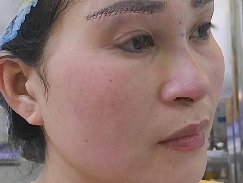 Nâng cung để lại sẹo khi có cảm giác đau, khó chịu kéo dài