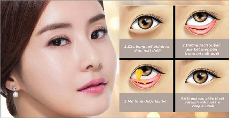 Lấy mỡ bọng mắt giúp trẻ hóa vùng mắt