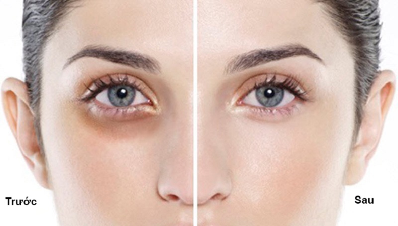 Phuật thuật lấy mỡ bọng mắt mí dưới khá đơn giản