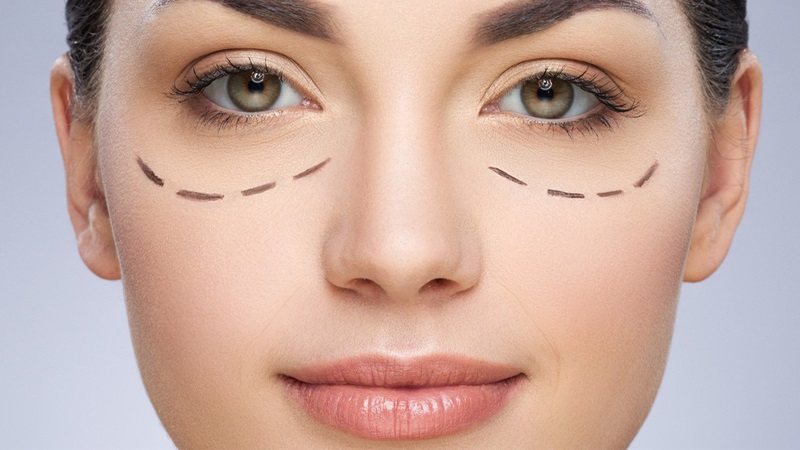 Lấy bọng mắt nội soi không để lại sẹo
