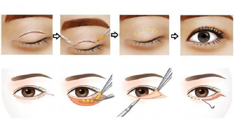 Lấy mỡ bọng mắt nội soi hiệu quả cao, thực hiện nhanh