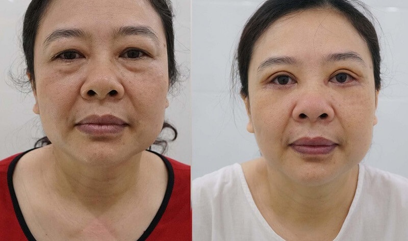 Lấy mỡ mắt nội soi có thể 5 năm hoặc vĩnh viễn
