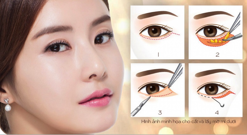 Lấy mỡ bọng mắt dưới kiêng ăn bao lâu?