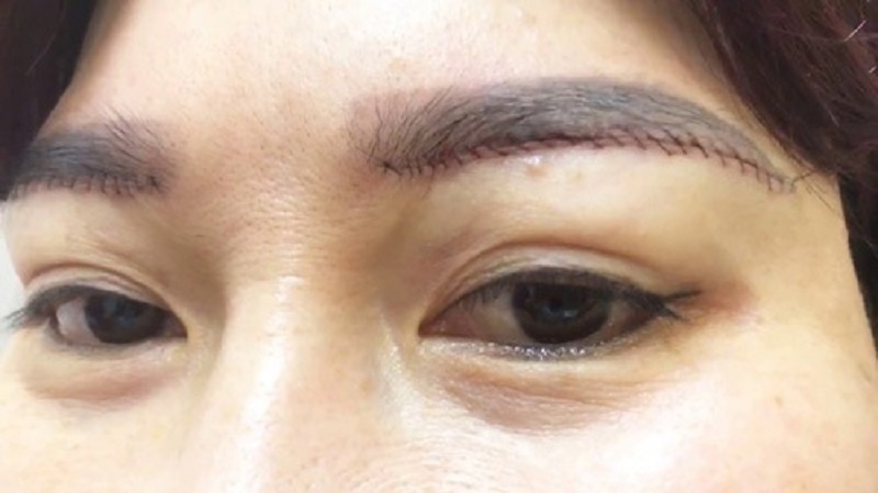 Nâng cung mày bằng cách rạch mổ giới hạn