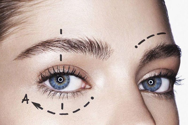 Nâng cung mày giúp loại bỏ da dư, mỡ thừa vùng mắt