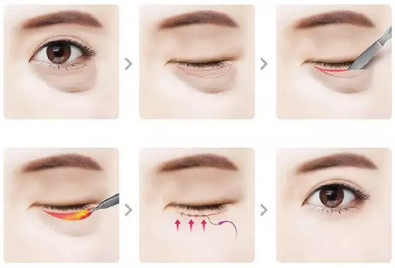 Phẫu thuật lấy mỡ bọng mắt hiệu quả nhanh