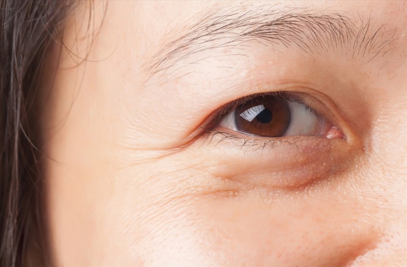 Cắt mí dưới giúp xóa nhăn hiệu quả