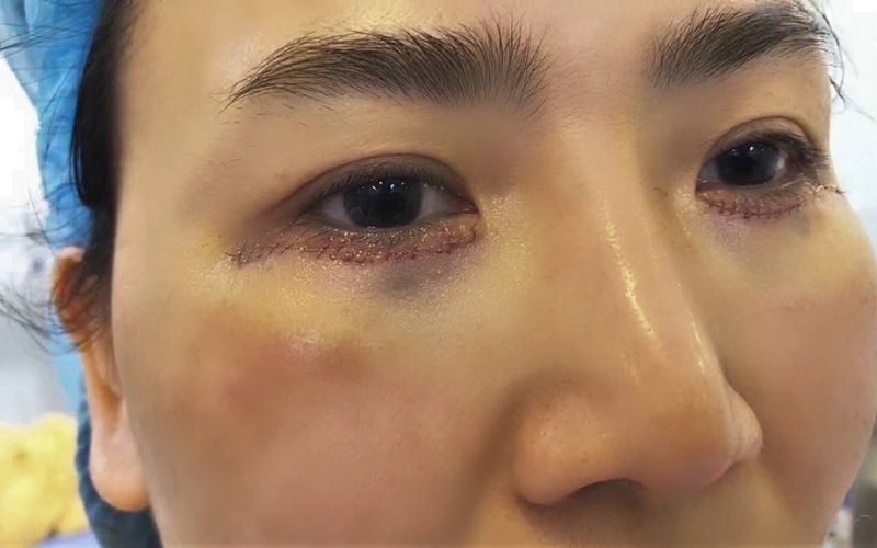 Cắt mí dưới không để lại sẹo