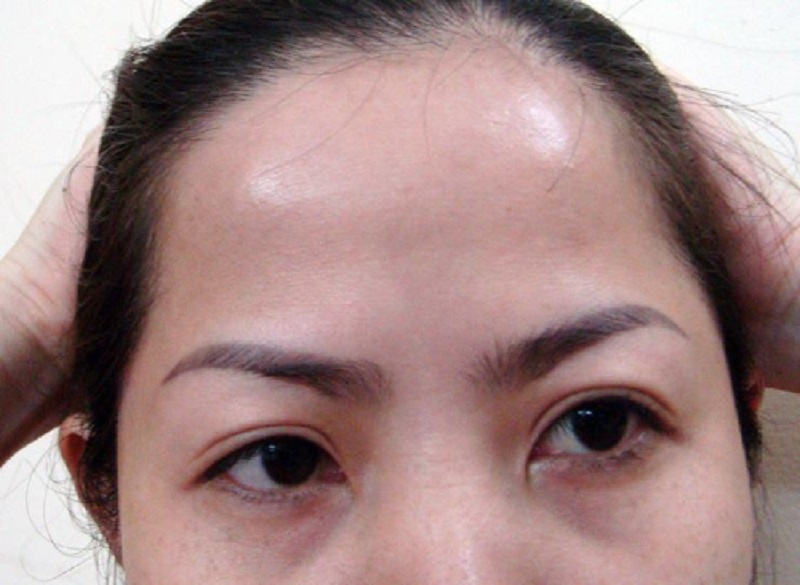 Chân mày lệch do tay nghề kỹ thuật viên thực hiện