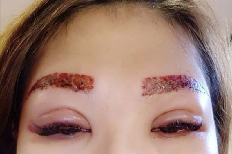 Lông mày hỏng sau phun xăm bong tróc thành mảng lớn
