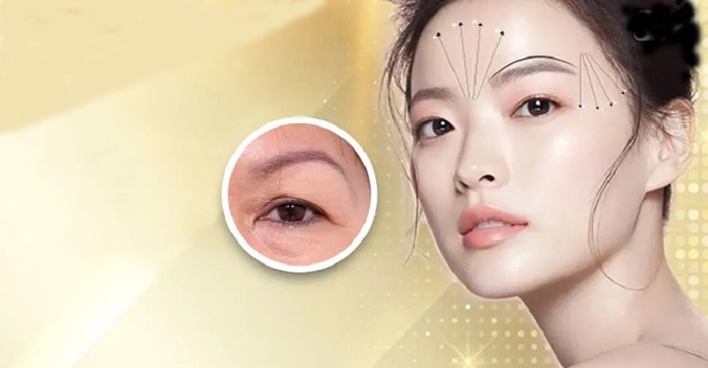 Treo mày xử lý mày hỏng da chùng là gì? Giải đáp cùng chuyên gia