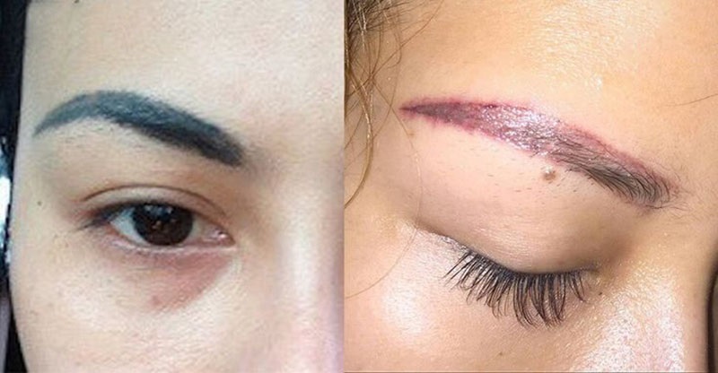 Treo mày phù hợp với mày hỏng, da chùng nhão