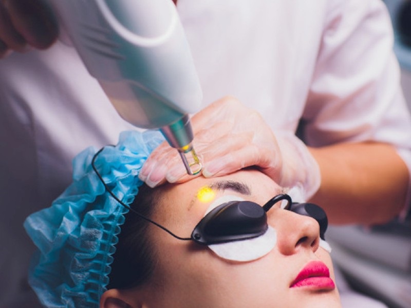 Xóa mày bằng Laser để sửa dáng