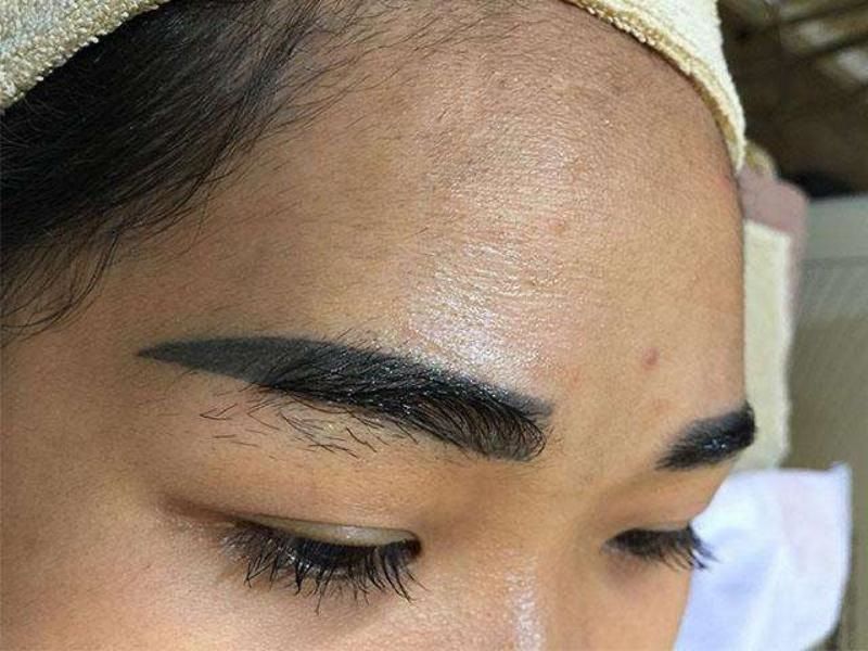 Xử lý mày hỏng giúp mang lại thẩm mỹ cho gương mặt
