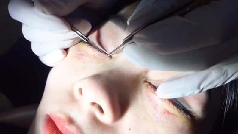Cắt chỉ mí dưới có đau không?