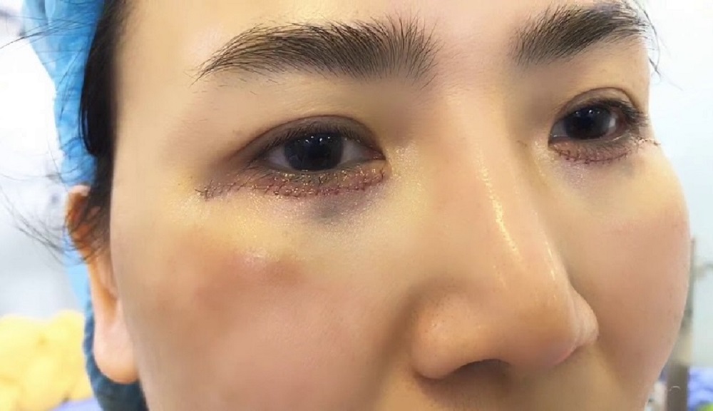 Cắt mí dưới giấu chỉ – Phương pháp trẻ hóa vùng mắt không để lại sẹo