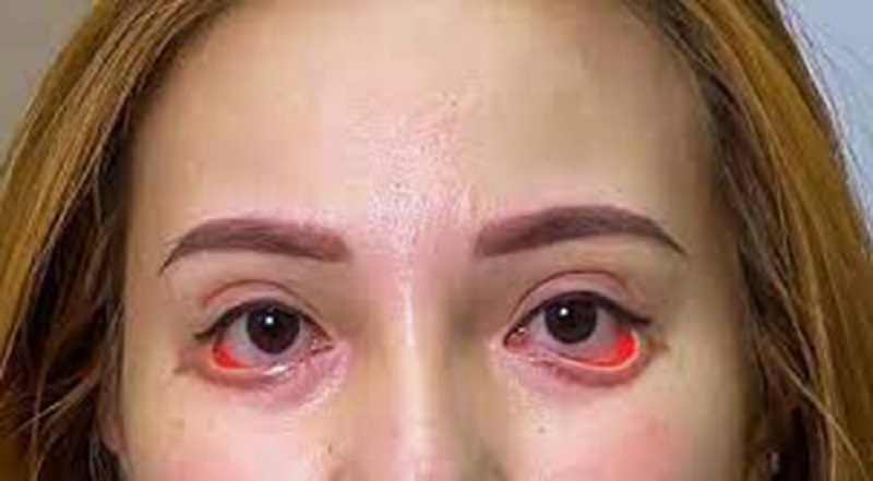 Lật mí do cắt mí dưới ở địa chỉ kém chất lượng