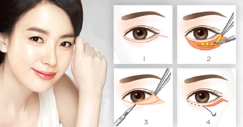 Cắt mí dưới giúp loại bỏ vùng da chảy xệ