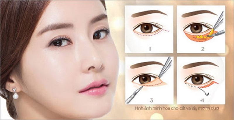 Công nghệ cắt mí dưới ảnh hưởng đến thời gian lành thương