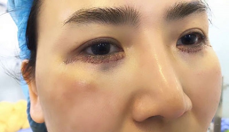 Cắt mí dưới có nguy hiểm không? Giải đáp từ Chuyên gia