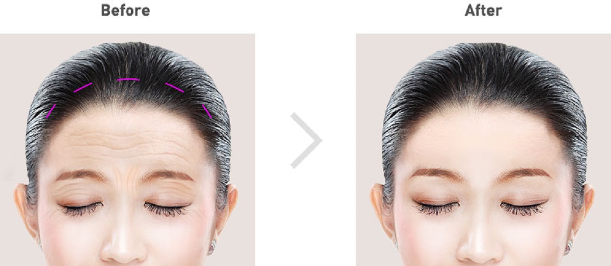 Kỹ thuật treo chân mày thực hiện như thế nào? Phù hợp với những ai?