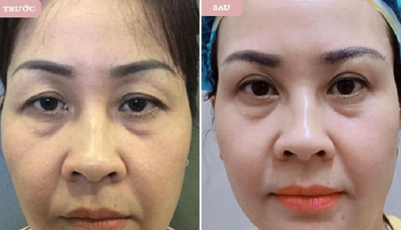 Phương pháp phẫu thuật treo chân mày