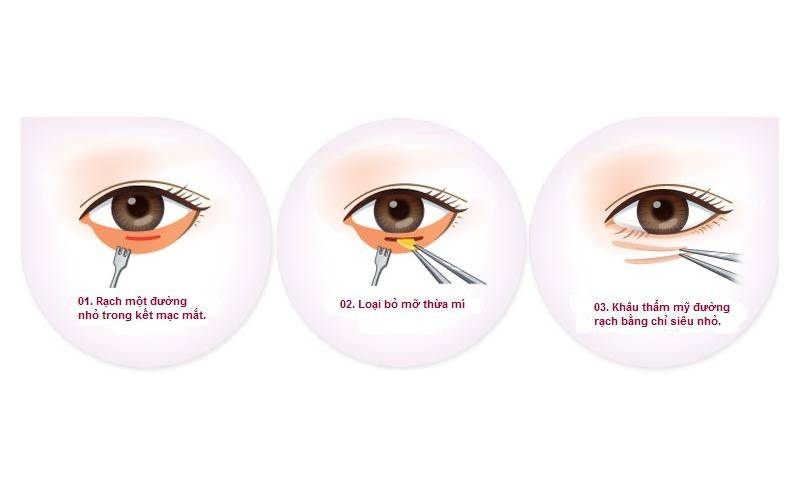 Quy trình cắt mí dưới an toàn, tính thẩm mỹ cao