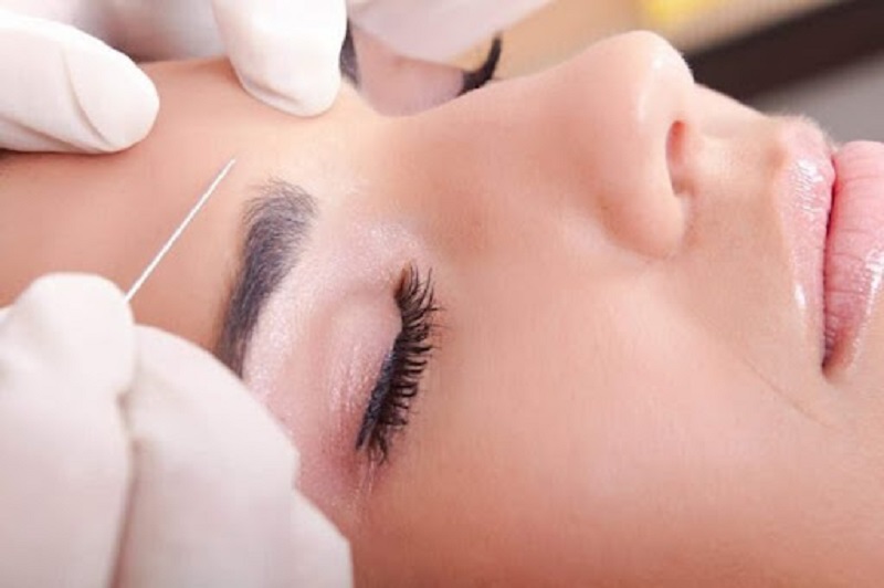 Treo mày giấu chỉ là phẫu thuật không xâm lấn