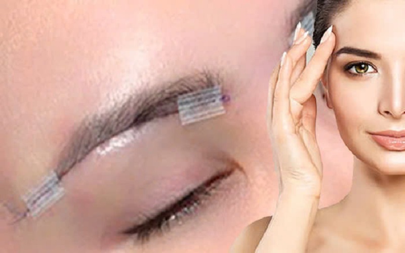 Treo mày duy trì hiệu quả 7 - 10 năm