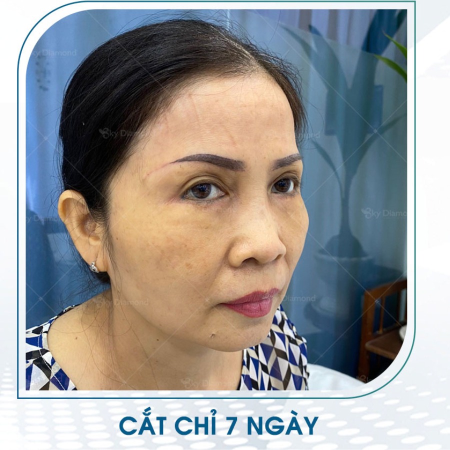 Cắt mí sụp giúp mí mắt to tròn