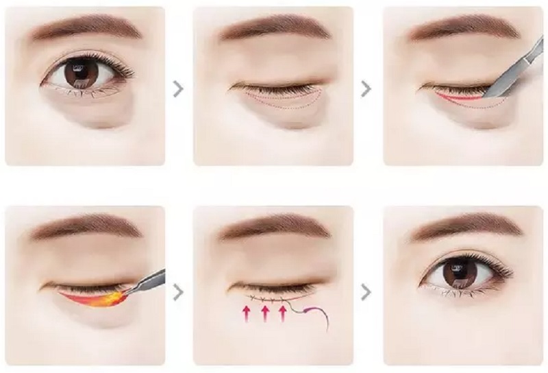 Lấy mỡ bọng mắt an toàn nếu thực hiện tại địa chỉ uy tín