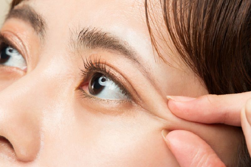 Lấy mỡ bọng mắt dưới giúp khắc phục bọng mỡ, da nhăn
