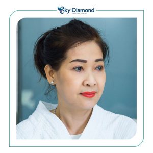 Các phương pháp phẫu thuật cắt mắt sụp mí phổ biến nhất