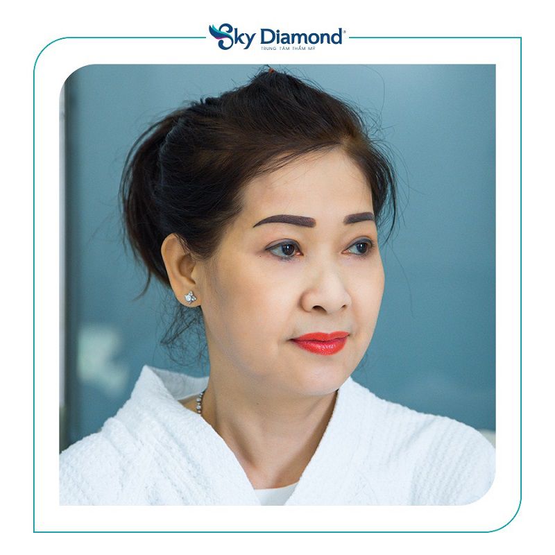Phẫu thuật cắt mắt sụp mí