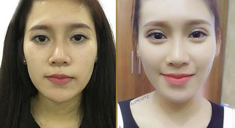 Phẫu thuật cắt sụp mí mắt giúp cải thiện thẩm mỹ và thị lực