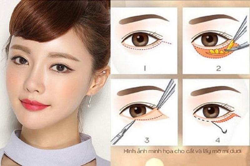 Quy trình phẫu thuật lấy mỡ bọng mắt mí dưới