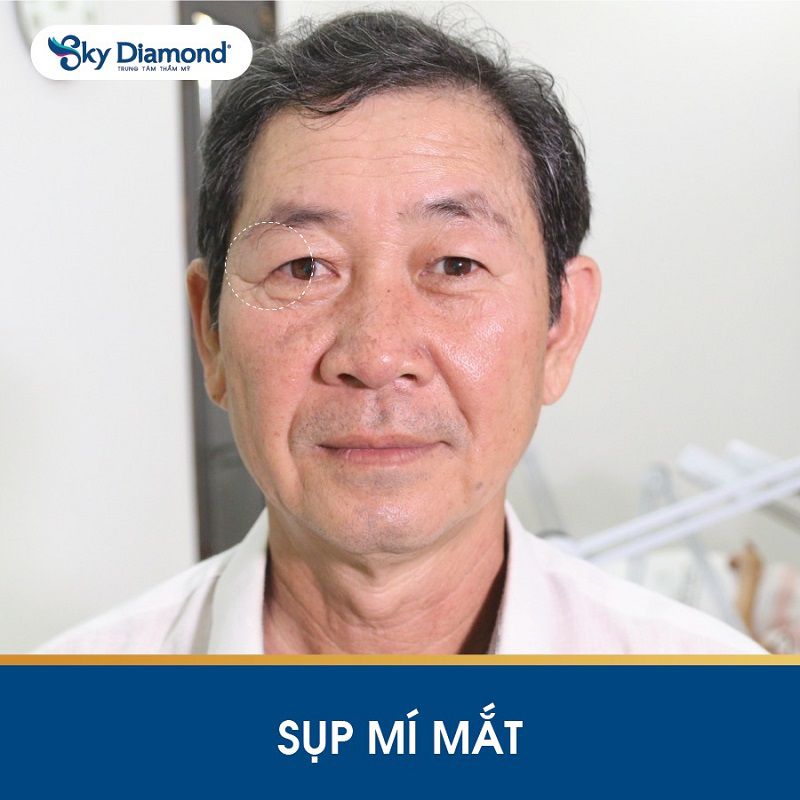 Sụp mí là tình trạng 2 mí mắt không cân xứng