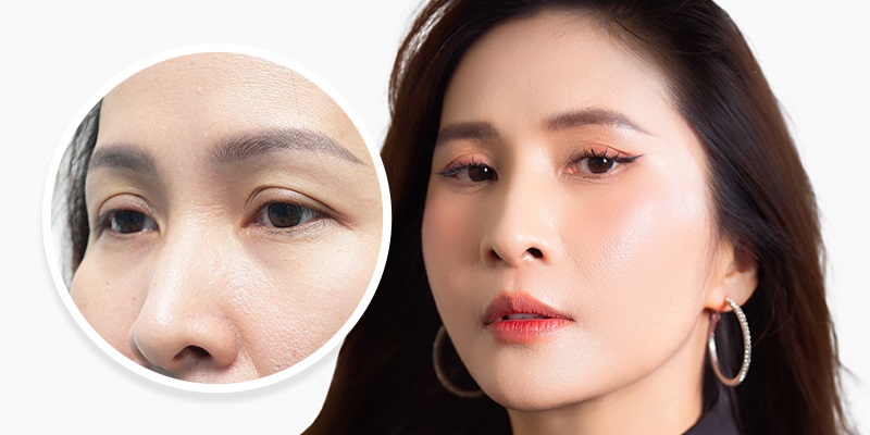 Nâng cung chân mày Mailisa được đánh giá cao
