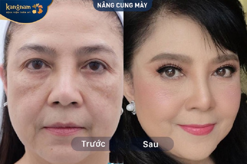 Nâng cung chân mày Kangnam phù hợp từng gương mặt