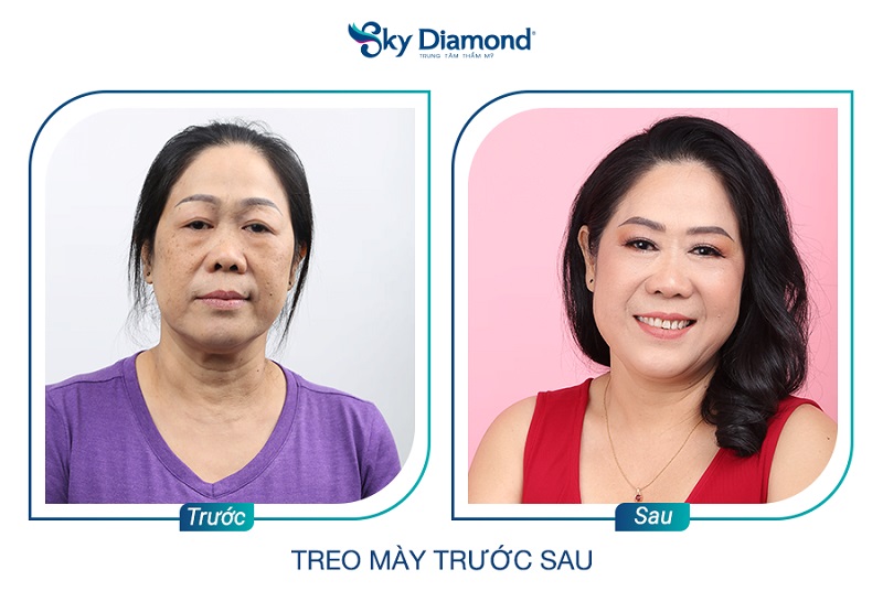 Xây dựng một chế độ sinh hoạt hợp lý sau nâng cung mày