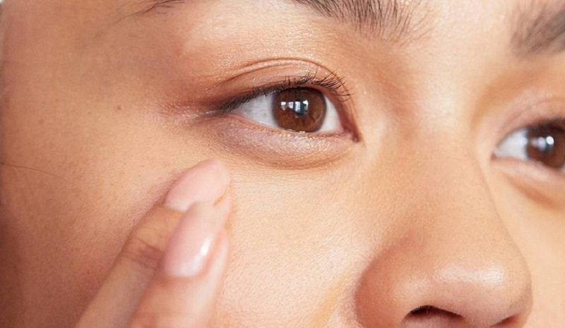 Lấy mỡ mí mắt khi xuất hiện bọng mắt, quầng thâm gây mất thẩm mỹ