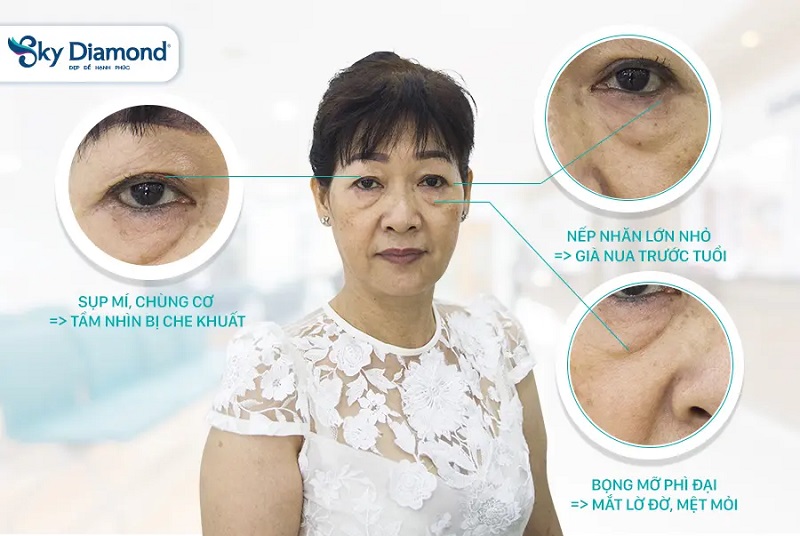 Treo mày tại địa chỉ uy tín không để lại sẹo