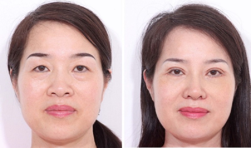 Cắt bọng mỡ không ảnh hưởng đến thị lực