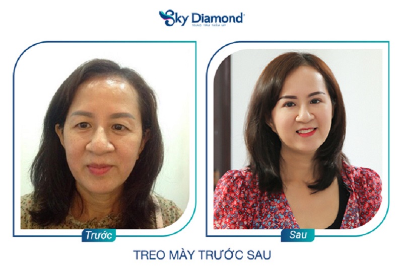 Cắt mắt cho độ tuổi trung niên khó khăn hơn người trẻ tuổi