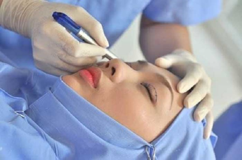Cắt mắt không hề sưng đau