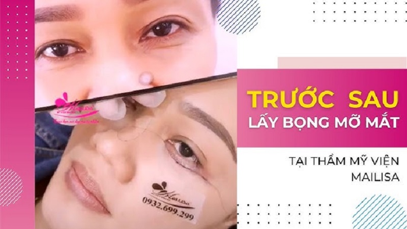 Mailisa lấy mỡ bọng mắt độc quyền