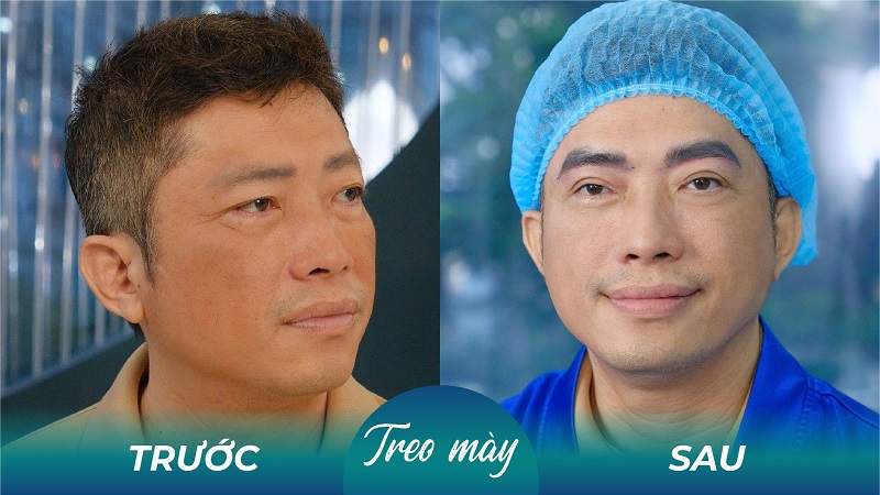 Bầm tím sau nâng cung sẽ biến mất nhanh chóng